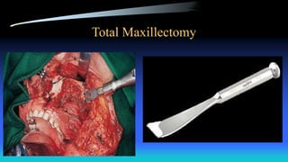 Total Maxillectomy
 