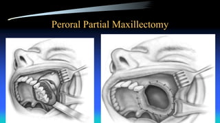 Peroral Partial Maxillectomy
 