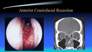 Anterior Craniofacial Resection
 