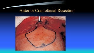 Anterior Craniofacial Resection
 