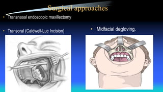 Surgical approaches
• Transnasal endoscopic maxillectomy
• Transoral (Caldwell-Luc Incision) • Midfacial degloving.
 
