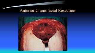 Anterior Craniofacial Resection
 