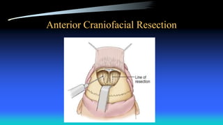 Anterior Craniofacial Resection
 