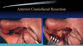 Anterior Craniofacial Resection
 