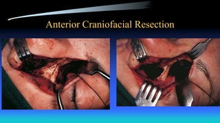 Anterior Craniofacial Resection
 