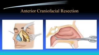 Anterior Craniofacial Resection
 