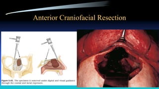 Anterior Craniofacial Resection
 