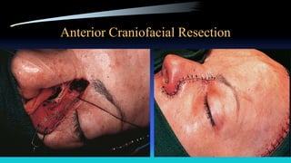 Anterior Craniofacial Resection
 