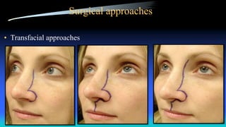 Surgical approaches
• Transfacial approaches
 
