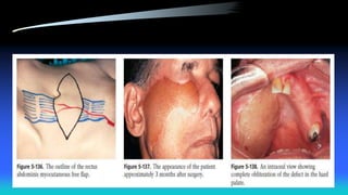 Maxillectomy and craniofacial resection 