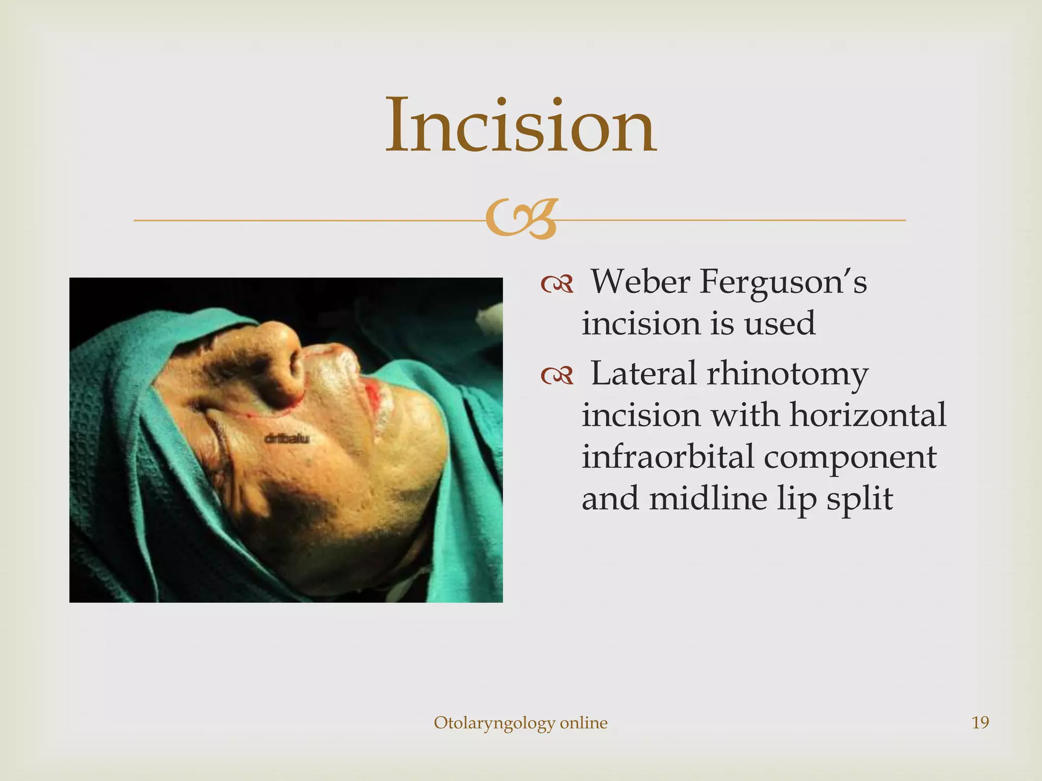 Incision
   
              Weber Ferguson’s
              incision is used
              Lateral rhinotomy
              incision with horizontal
              infraorbital component
              and midline lip split




 Otolaryngology online                   19
 