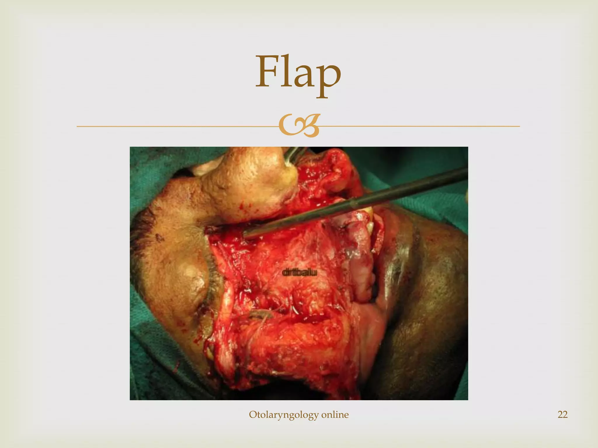 Flap
  




Otolaryngology online   22
 