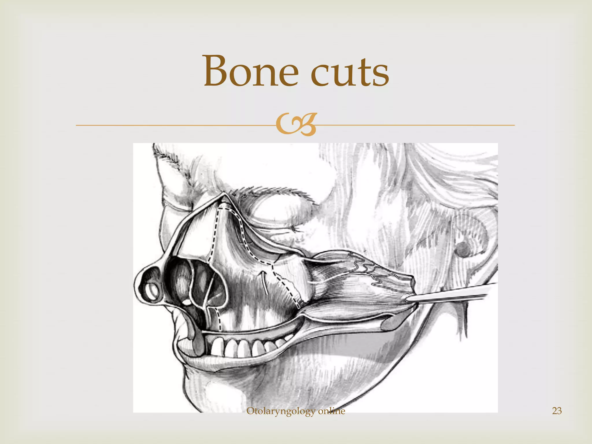 Bone cuts
   




  Otolaryngology online   23
 