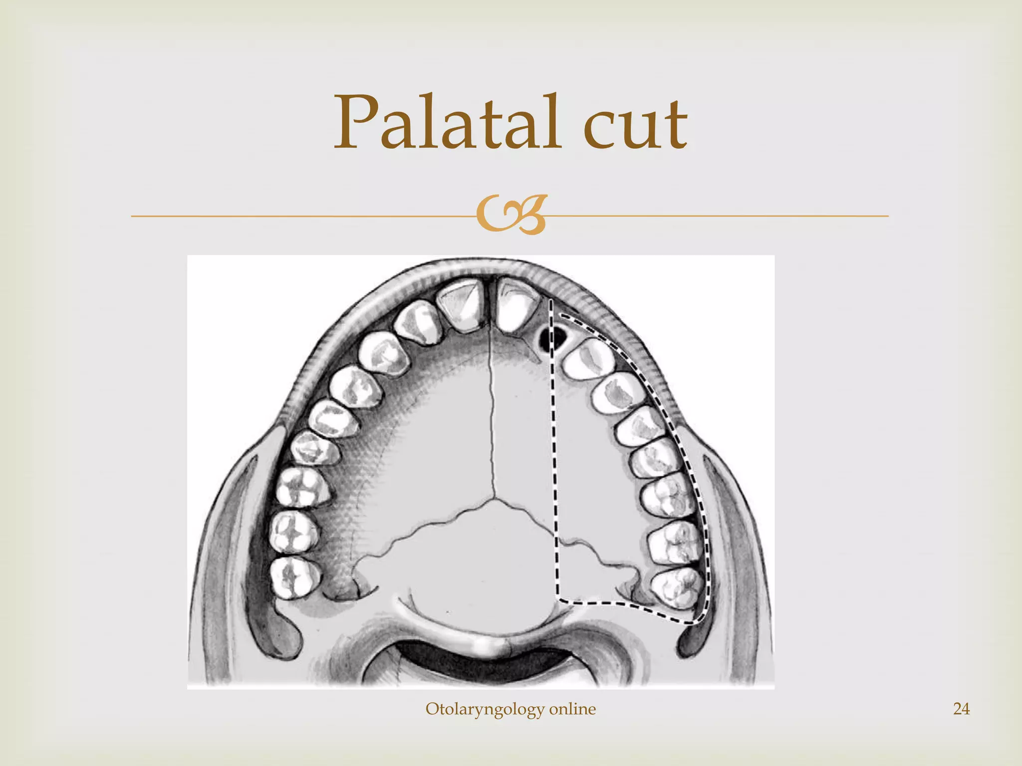 Palatal cut
    




  Otolaryngology online   24
 