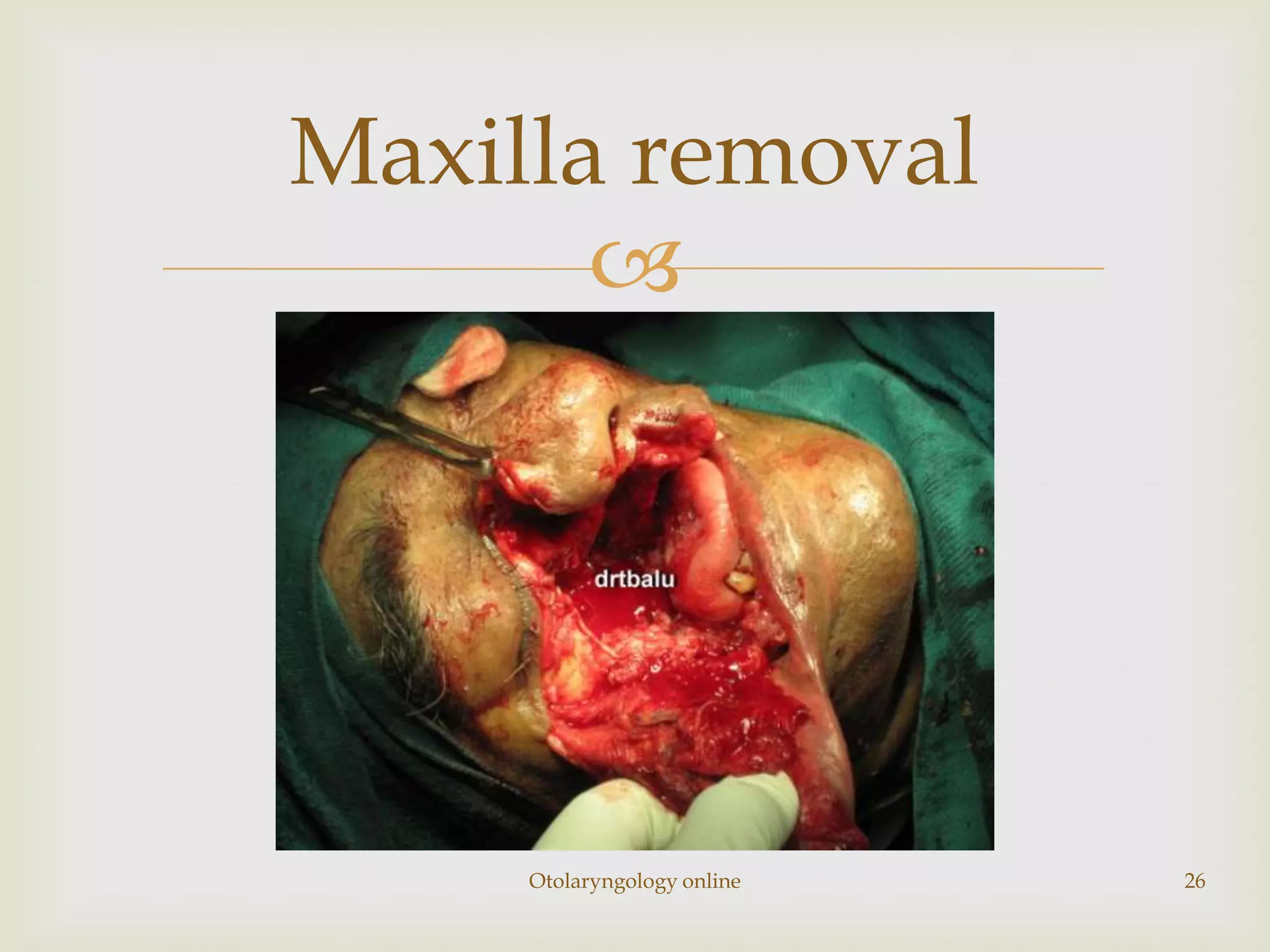 Maxilla removal
       




     Otolaryngology online   26
 