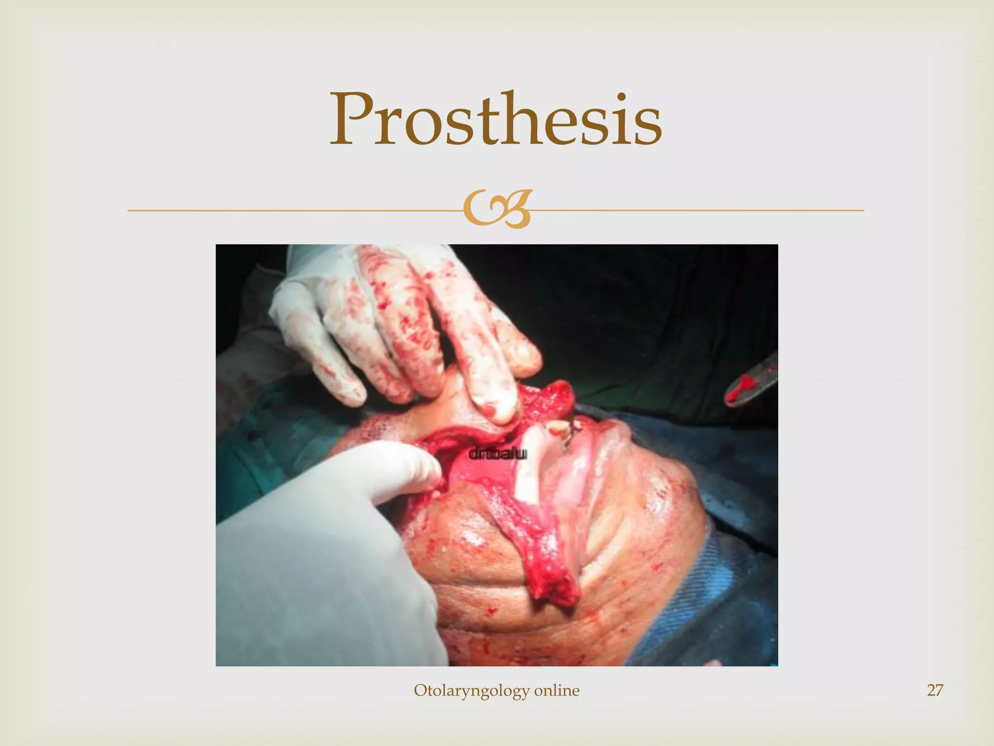 Prosthesis
    




  Otolaryngology online   27
 