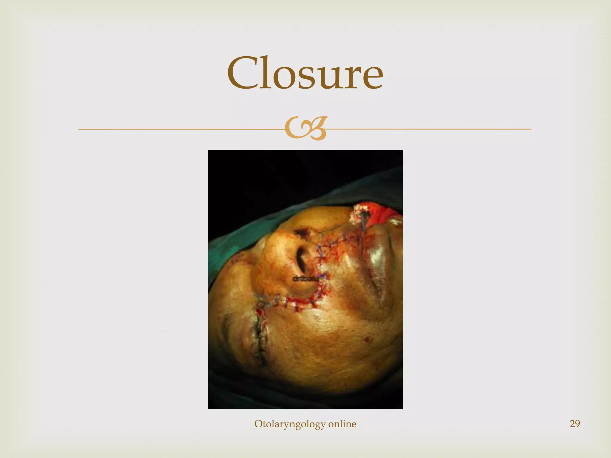 Closure
  




 Otolaryngology online   29
 