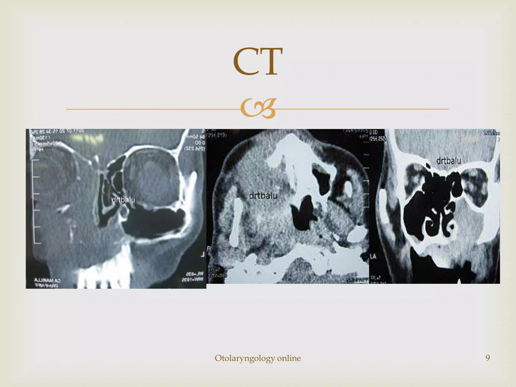CT
    




Otolaryngology online   9
 