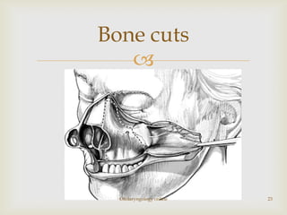 Bone cuts
   




  Otolaryngology online   23
 