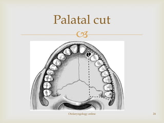 Palatal cut
    




  Otolaryngology online   24
 