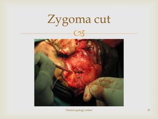 Zygoma cut
    




  Otolaryngology online   25
 