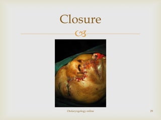 Closure
  




 Otolaryngology online   29
 