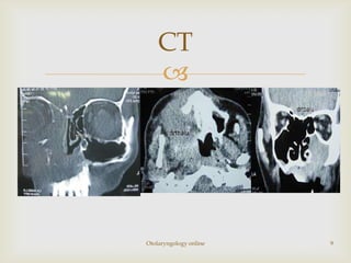 CT
    




Otolaryngology online   9
 
