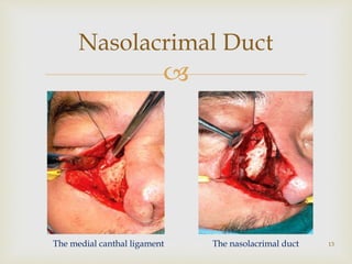 
13
Nasolacrimal Duct
The medial canthal ligament The nasolacrimal duct
 