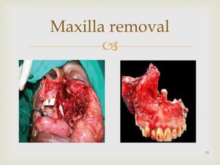 
Maxilla removal
15
 