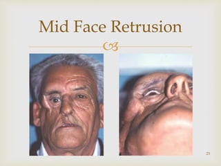 
Mid Face Retrusion
23
 