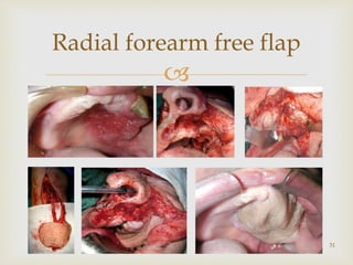 
Radial forearm free flap
31
 
