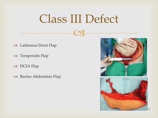
Class III Defect
32
 Lattismus Dorsi Flap
 Temporalis Flap
 DCIA Flap
 Rectus Abdominis Flap
 