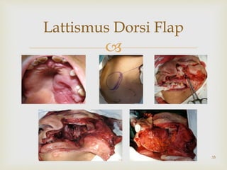 
Lattismus Dorsi Flap
33
 