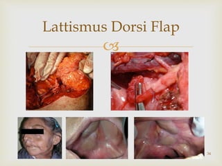 
Lattismus Dorsi Flap
34
 