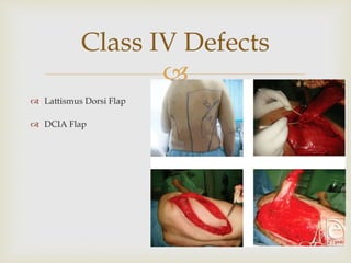 
Class IV Defects
35
 Lattismus Dorsi Flap
 DCIA Flap
 