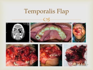 
Temporalis Flap
37
 