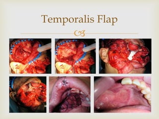 
Temporalis Flap
38
 