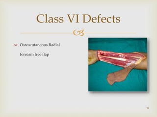 
Class VI Defects
39
 Osteocutaneous Radial
forearm free flap
 