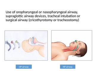 Use of oropharyngeal or nasopharyngeal airway,
supraglottic airway devices, tracheal intubation or
surgical airway (cricothyrotomy or tracheostomy)
OP airway NP airway
 