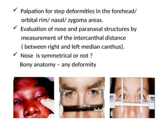  Palpation for step deformities in the forehead/
orbital rim/ nasal/ zygoma areas.
 Evaluation of nose and paranasal structures by
measurement of the intercanthal distance
( between right and left median canthus).
 Nose is symmetrical or not ?
Bony anatomy – any deformity
 