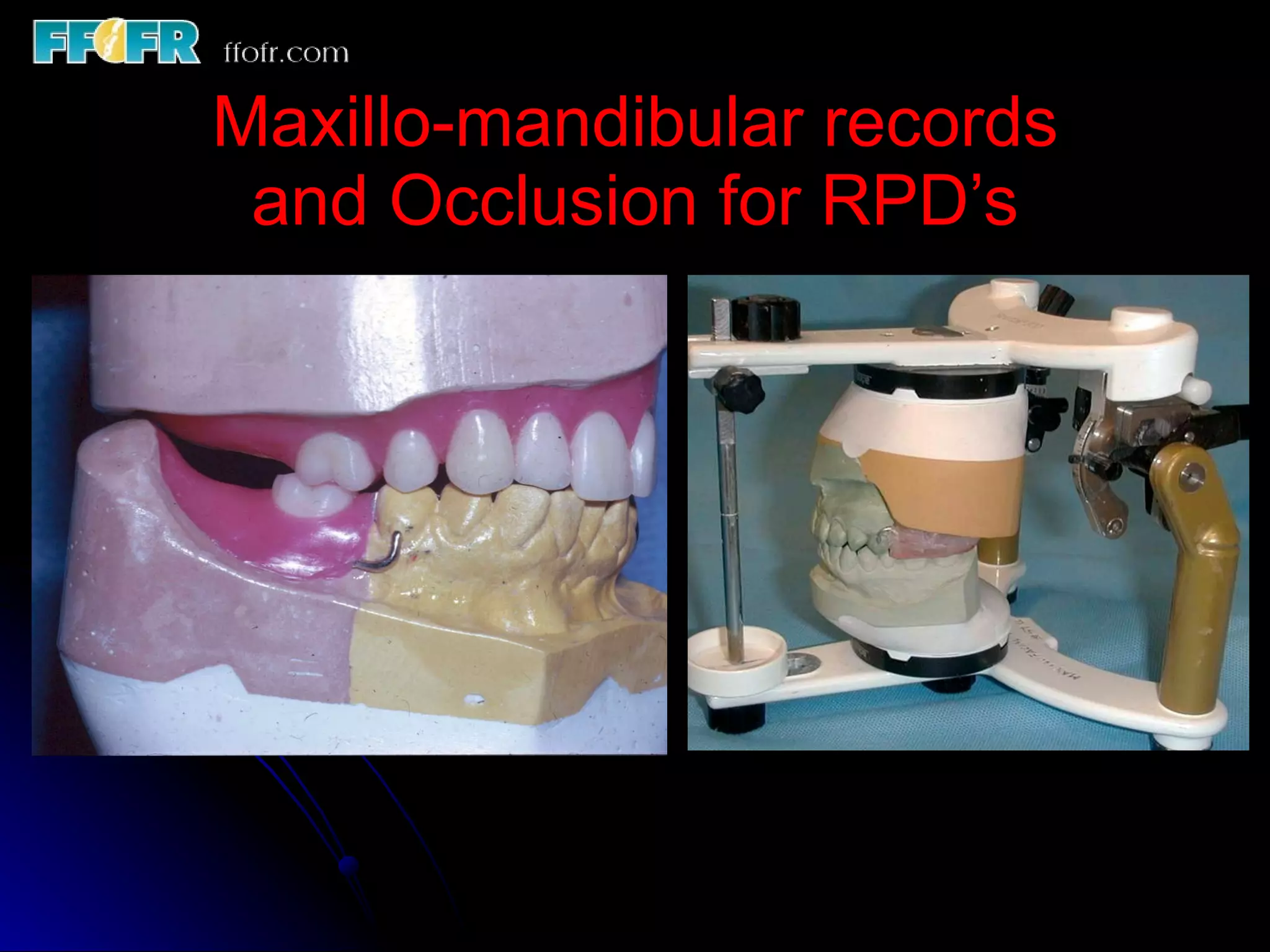 Mandiblar Rpd Maxillo mandibular records | PPT