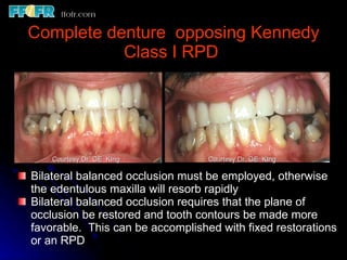 K2 Rpd Maxilaly Maxillo mandibular records | PPT