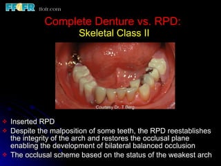 K2 Rpd Maxilaly Maxillo mandibular records | PPT