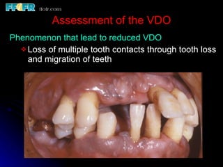 Maxillo mandibular records | PPT