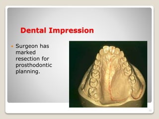 Dental Impression 
 Surgeon has 
marked 
resection for 
prosthodontic 
planning. 
12 
 