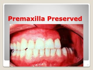 Premaxilla Preserved 
37 
 