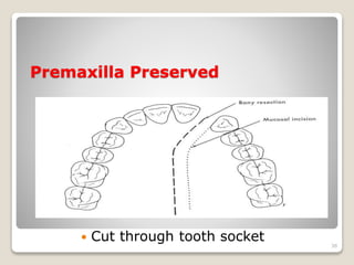 Premaxilla Preserved 
 Cut through tooth socket 
38 
 