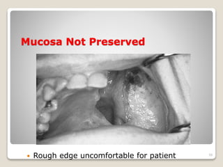 Mucosa Not Preserved 
 Rough edge uncomfortable for patient 39 
 