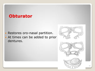 Obturator 
 Restores oro-nasal partition. 
 At times can be added to prior 
dentures. 
40 
 