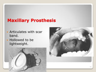 Maxillary Prosthesis 
 Articulates with scar 
band. 
 Hollowed to be 
lightweight. 
42 
 